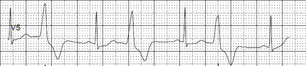 Szapora szívverés (tachycardia): 12 módszer, hogy csillapítsa a szívdobogást